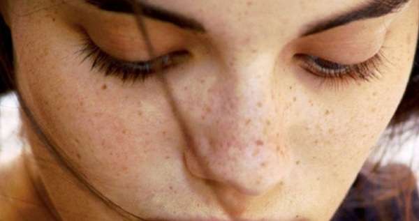 How to Get Rid of Dark Spots on Dark Skin
