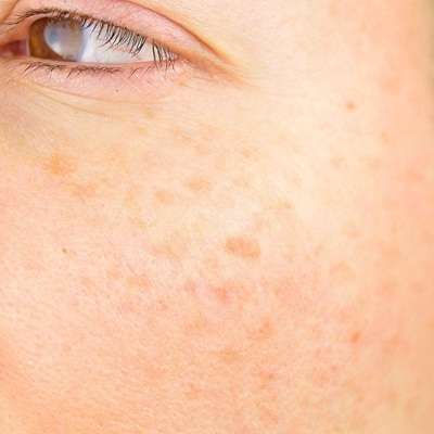 How to Get Rid of Dark Spots on Dark Skin