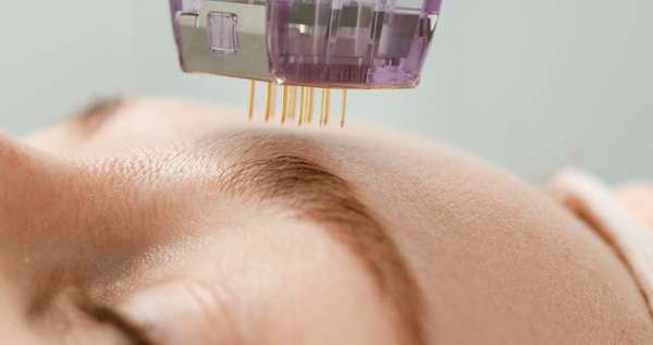 Is RF Microneedling for Sagging Skin?