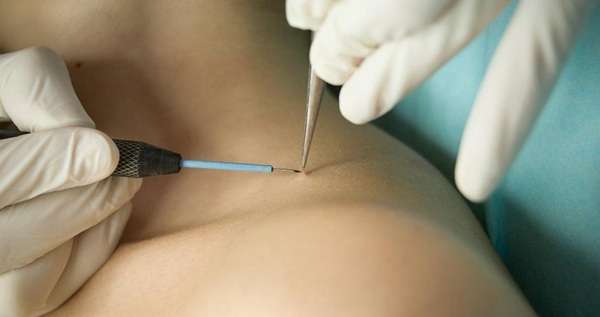 Types of Warts and Best Treatment Options