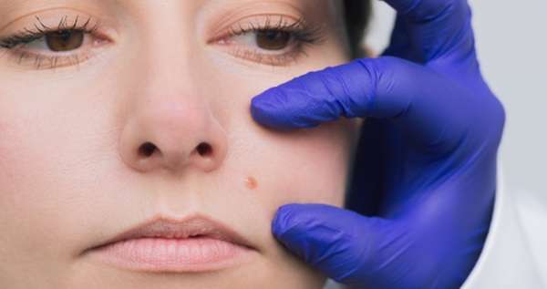 How to Remove a Birthmark Mole?