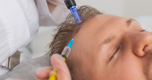 Exploring the Benefits of Exosomes for Hair Loss