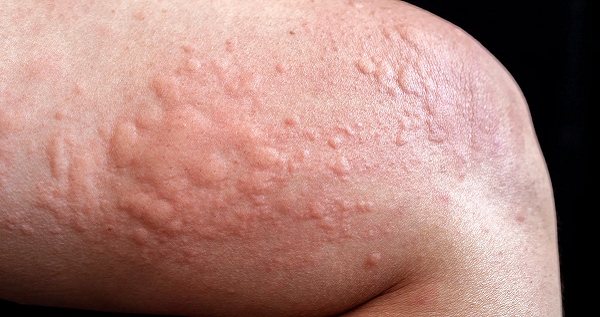 Best Skin Allergy Treatments and How to Prevent Future Reactions