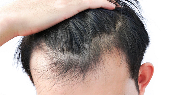 PRP for Hair Regrowth: Best Treatment for Baldness and Hair Thinning