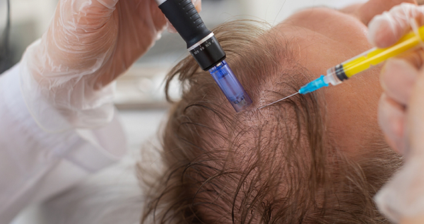 Stem Cell Therapy for Hair Loss: Does It Really Regrow Hair?