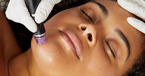 HydraFacial for Open Pores and Uneven Skin Texture