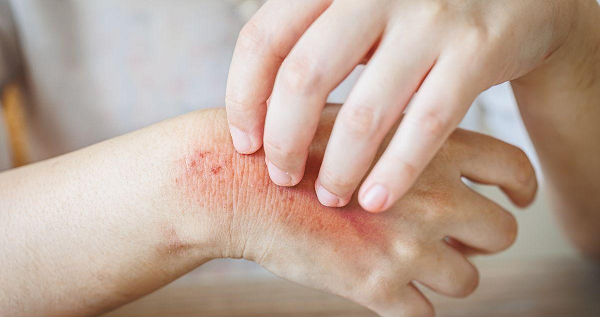 Fungal Skin Infection Treatment: Fast Relief and Prevention Tips