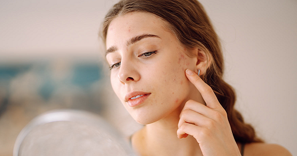 Oily Skin and Acne Treatment Routine Recommended by Skin Specialists