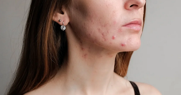Stem Cell Therapy for Acne Scars and Skin Repair Results