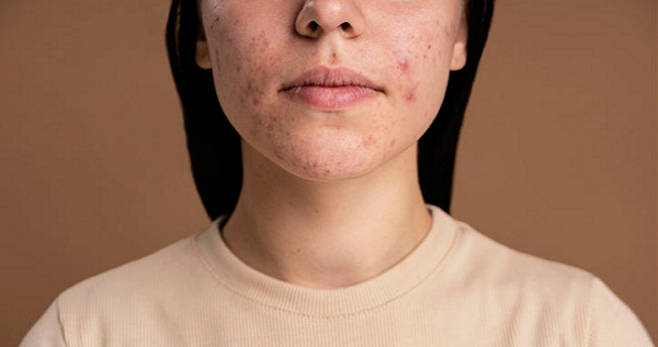 Black Spots on Face Treatment: Dermatologist-Approved Solutions