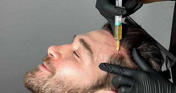 PRP for Male Pattern Hair Loss: Can It Really Help Regrow Hair?