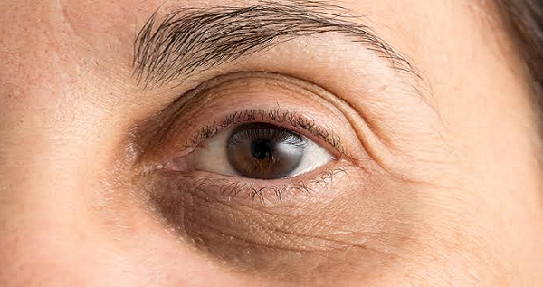Under Eye Fillers for Dark Circles: Do They Really Work?