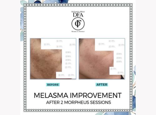 Melasma Treatment Melasma Treatment