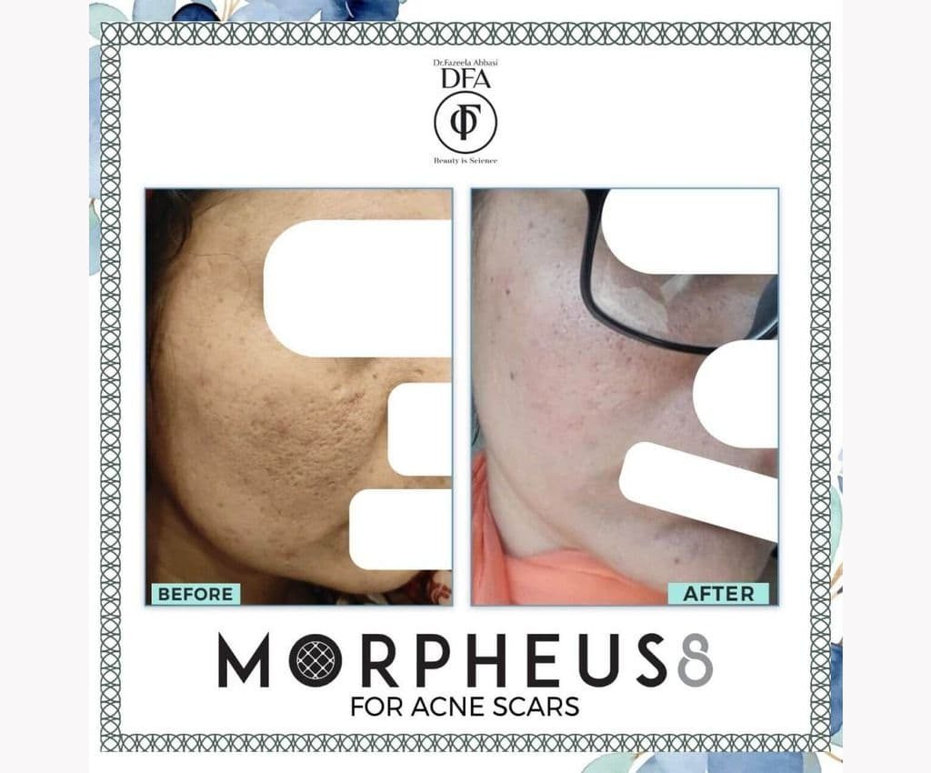 Morpheus8 Treatment Morpheus8 Treatment
