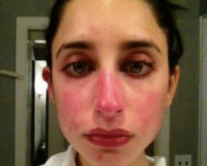 rosacea treatment rosacea treatment